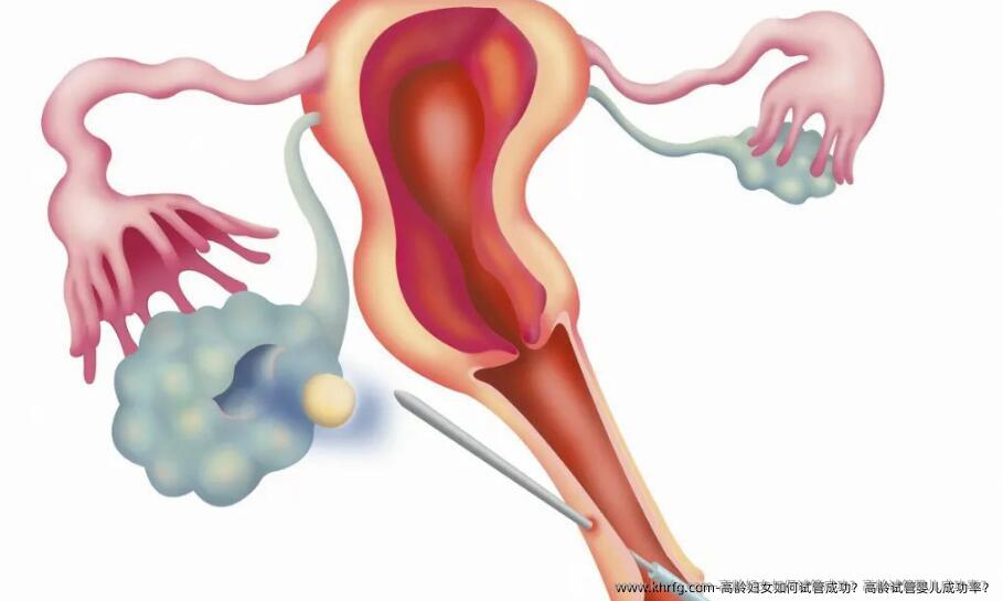 高龄妇女如何试管成功？高龄试管婴儿成功率？