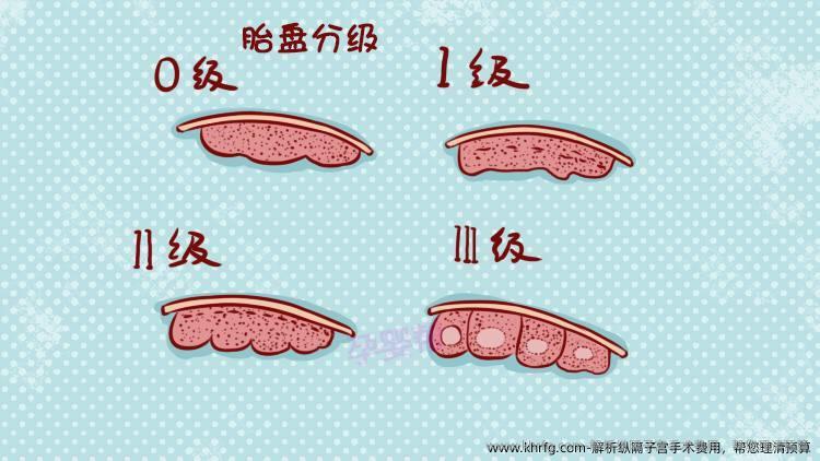 解析纵隔子宫手术费用，帮您理清预算
