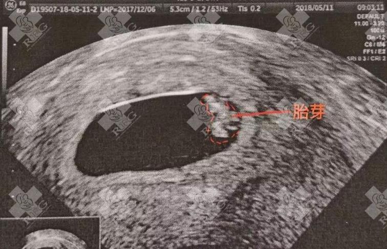 移植囊胚测不出来有没有时间限制说明失败了?