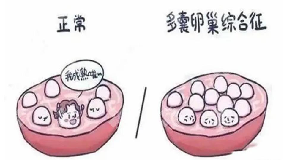 多囊卵巢很容易怀上双胎宝宝吗？