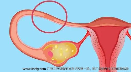 广州三代试管助孕生子价格一览，附广州助孕生子的试管医院