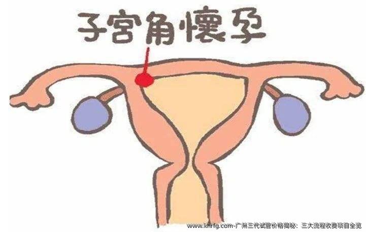 广州三代试管价格揭秘：三大流程收费项目全览