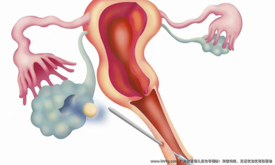 广州试管婴儿成功率揭秘！突破传统，见证优生优育新篇章