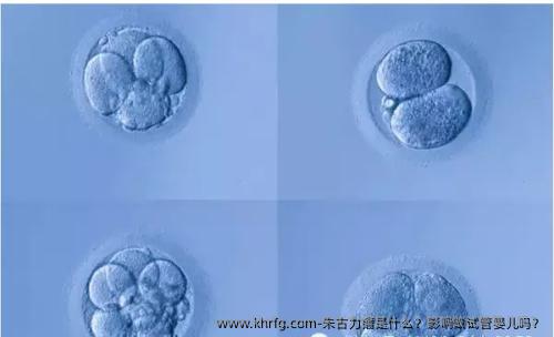 朱古力瘤是什么？影响做试管婴儿吗？