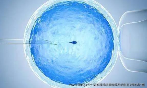 妇科疾病多囊卵巢综合征是否特别严重