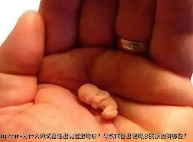 为什么做试管还出现宝宝畸形？导致试管出现畸形的原因有哪些？