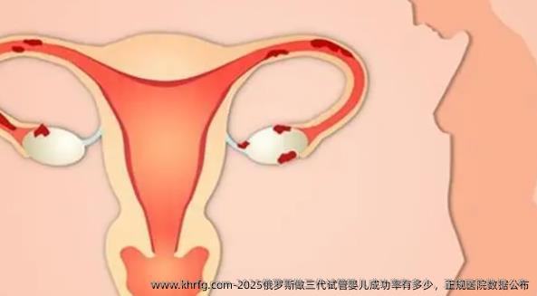 2025俄罗斯做三代试管婴儿成功率有多少，正规医院数据公布