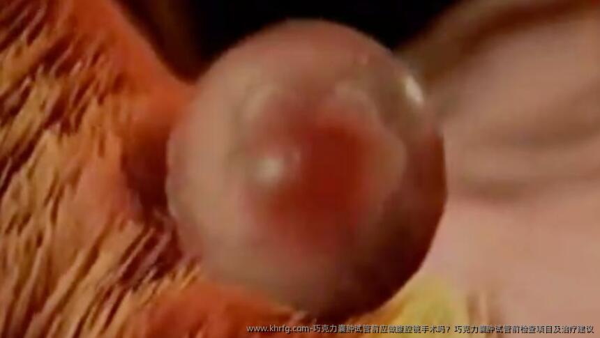巧克力囊肿试管前应做腹腔镜手术吗？巧克力囊肿试管前检查项目及治疗建议